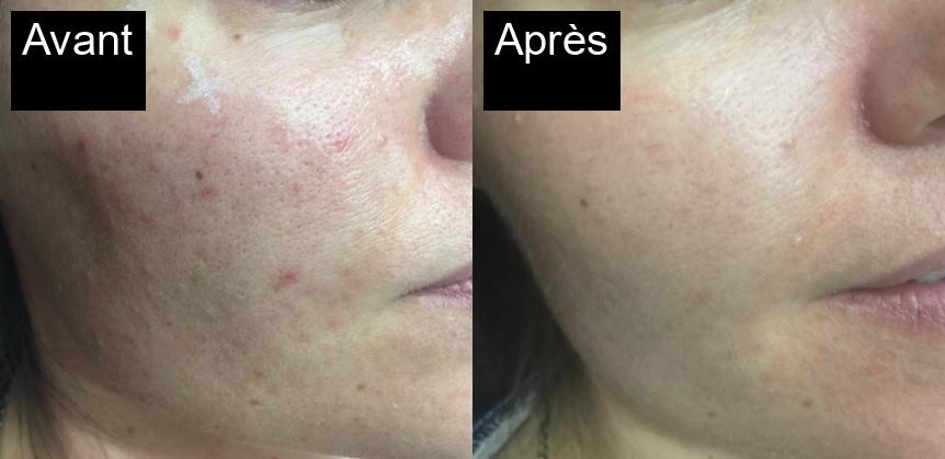 Avant / Après : Élimination des cicatrices d'acné avec IPL à Javea -4