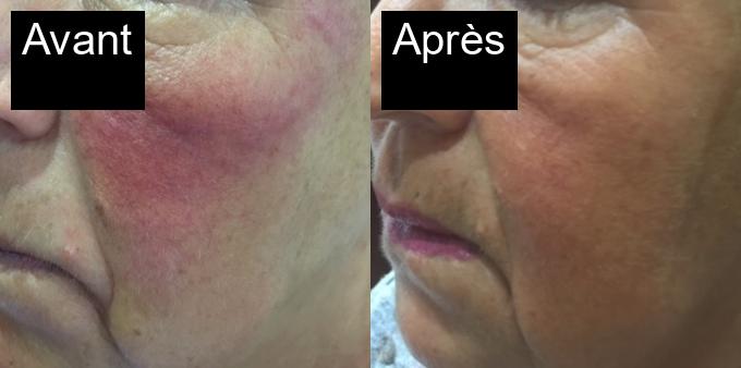 Avant / Après : Traitement de photorajeunissement à Javea -2