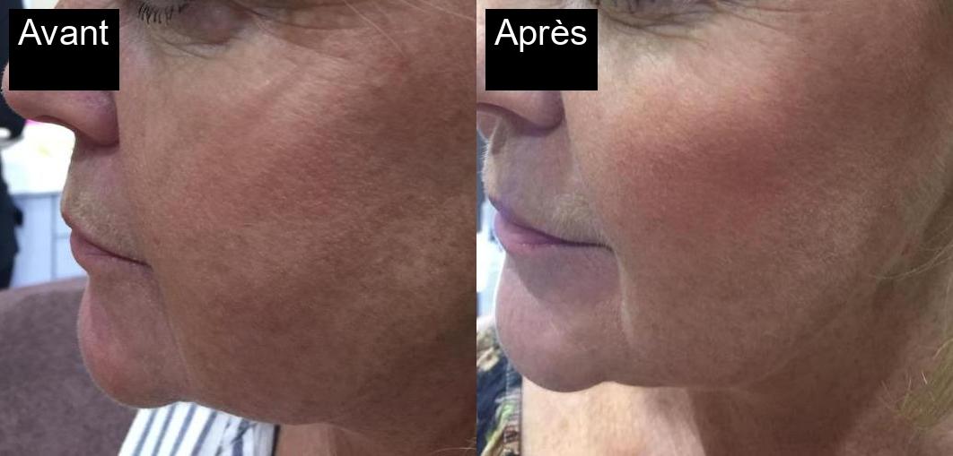 Avant / Après : Traitement de photorajeunissement à Javea -3